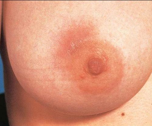 Mastitis