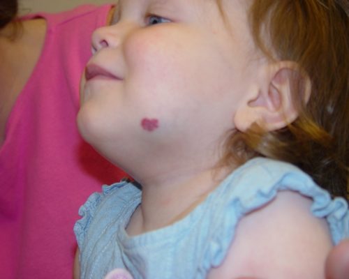 Baby birthmarks & rashes