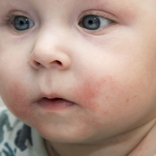 Heat rash